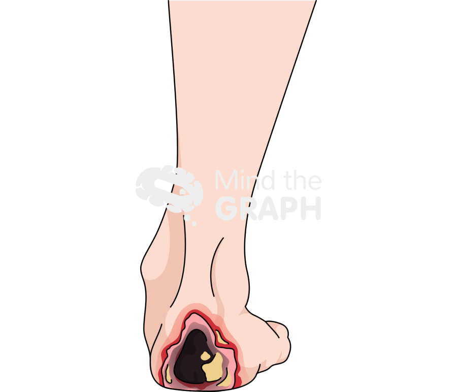 Pressure ulcer stages 3 Icons, Symbols, Pictures, and Images