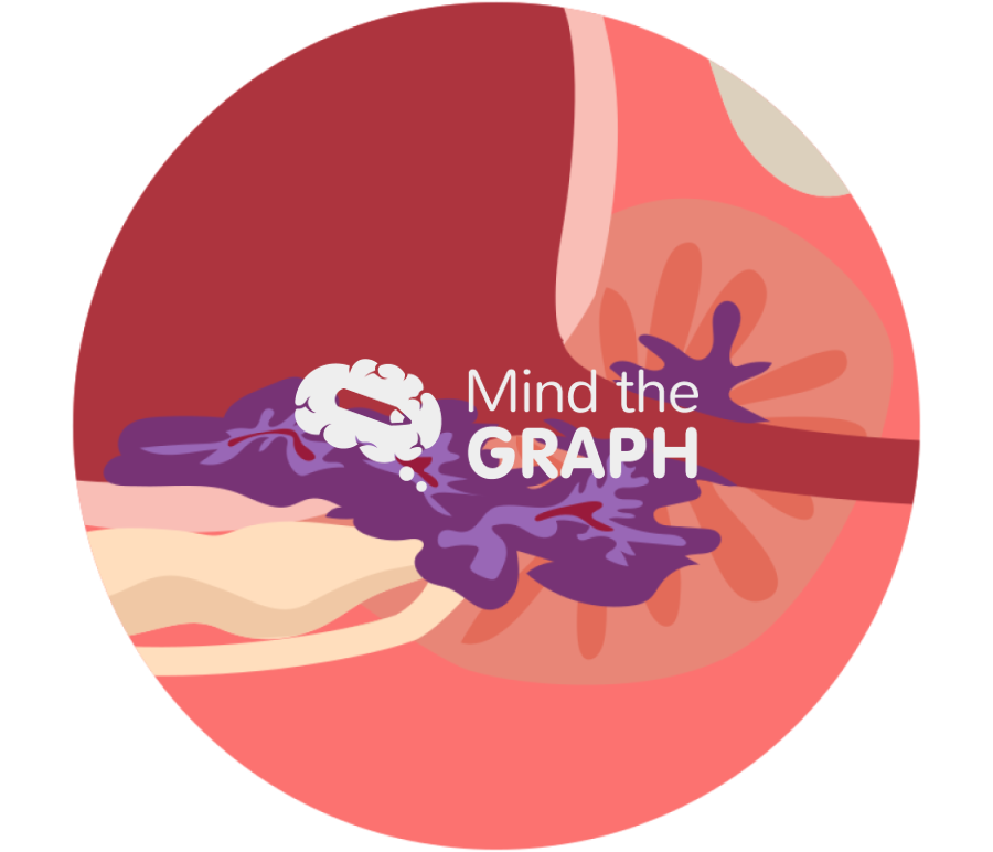 Prostate gland tumor infiltration zoom Icons, Symbols, Pictures, and Images