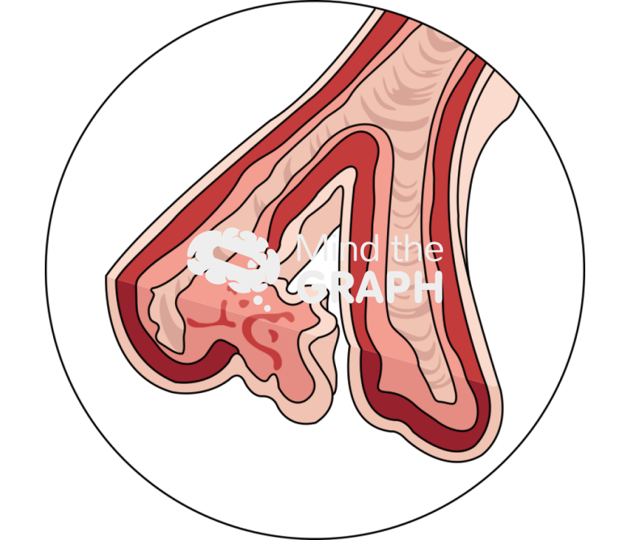 Pulmonary arterial hypertension zoom Icons, Symbols, Pictures, and Images