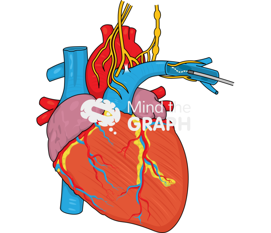 Pulmonary artery denervation padn Icons, Symbols, Pictures, and Images