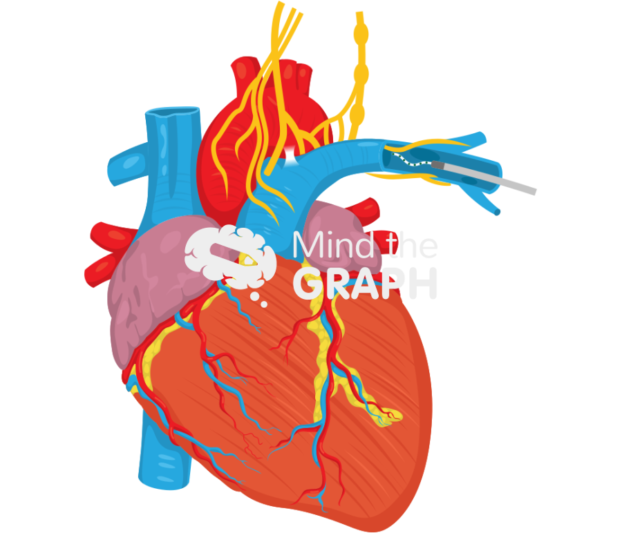 Pulmonary artery denervation padn Icons, Symbols, Pictures, and Images