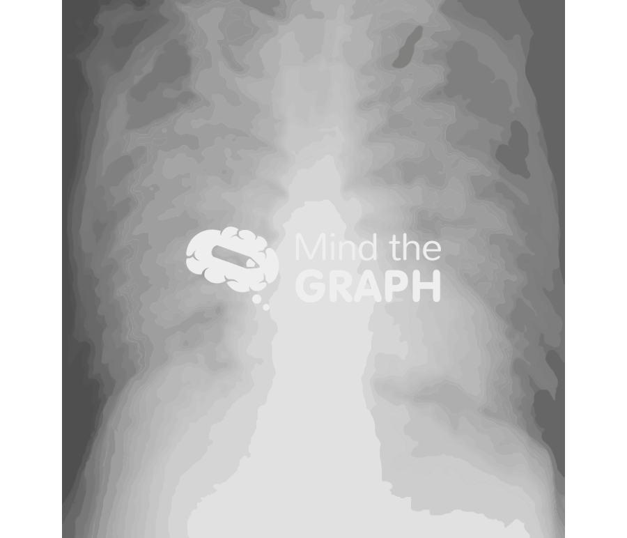Pulmonary congestion xray Icons, Symbols, Pictures, and Images
