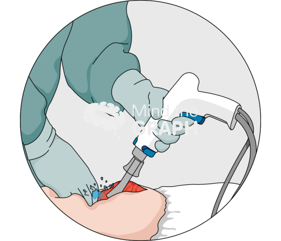 Pulse lavage zoom Icons, Symbols, Pictures, and Images