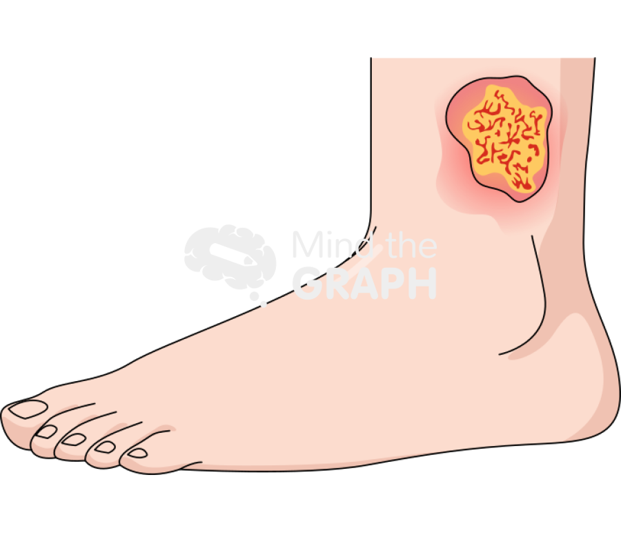 Pyoderma gangrenosa Icons, Symbols, Pictures, and Images