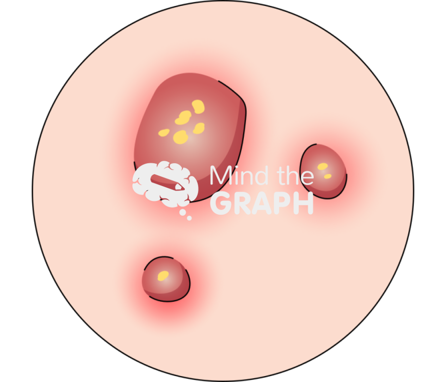 Pyogenic infection abcesses boils zoom Icons, Symbols, Pictures, and Images