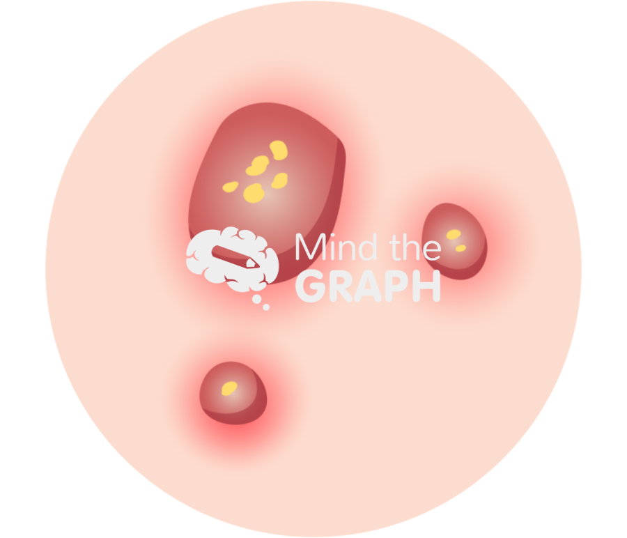 Pyogenic infection abcesses boils zoom Icons, Symbols, Pictures, and Images