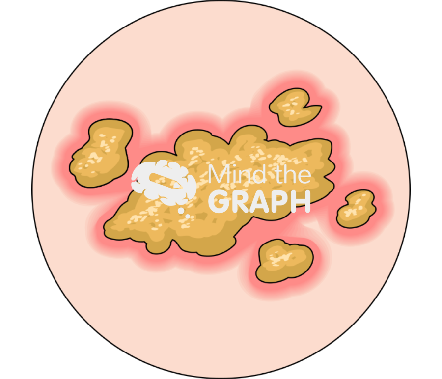 Pyogenic infection impetigo zoom Icons, Symbols, Pictures, and Images