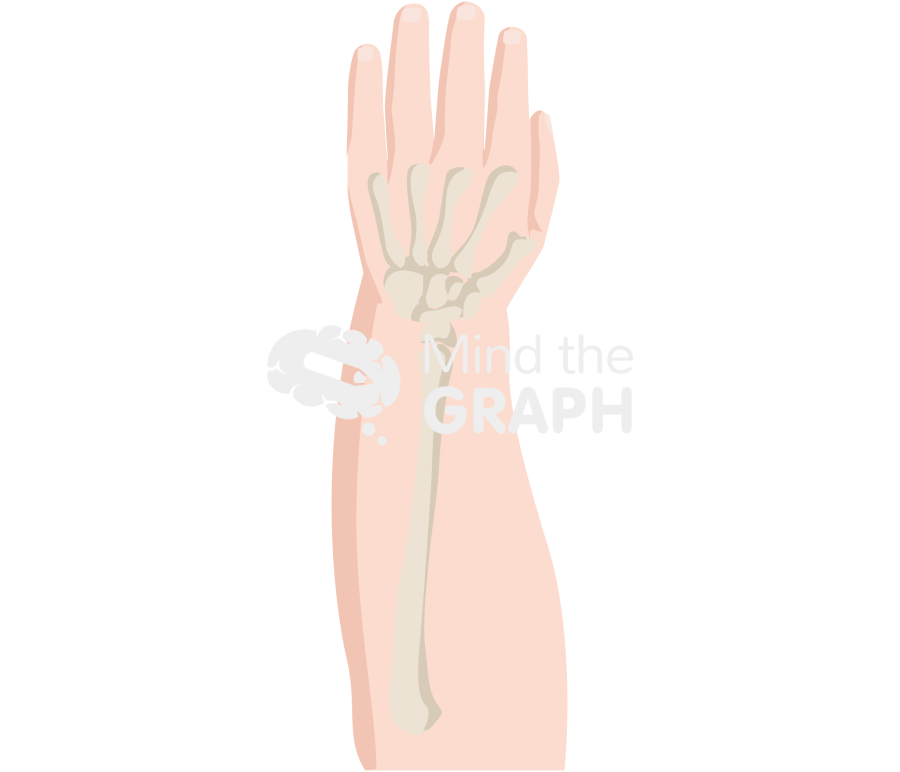 Radial aplasia treatments centralization Icons, Symbols, Pictures, and Images