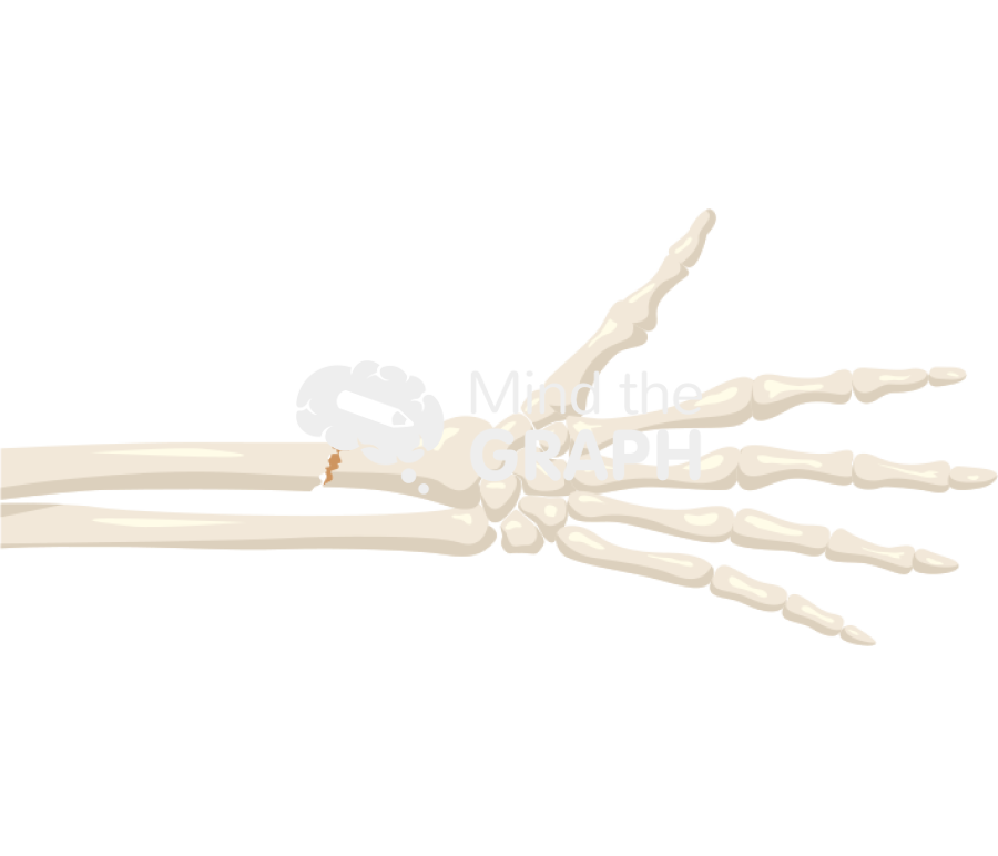 Radius fracture 2 Icons, Symbols, Pictures, and Images
