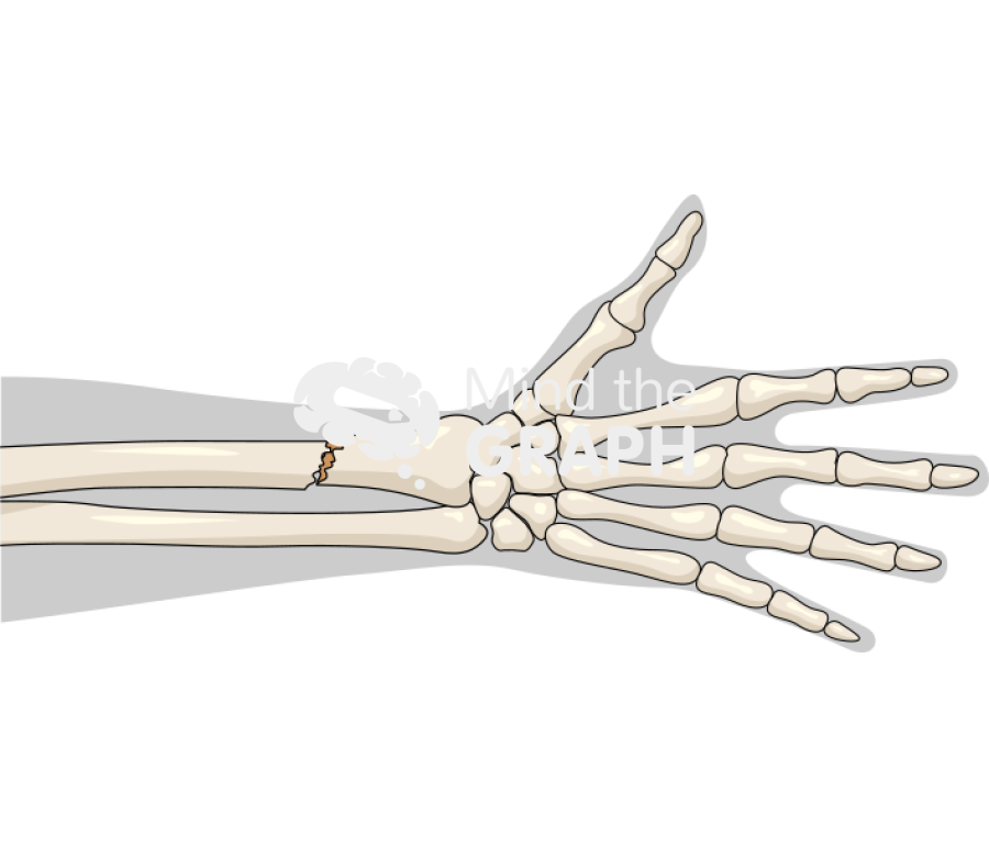 Radius fracture 2 body Icons, Symbols, Pictures, and Images
