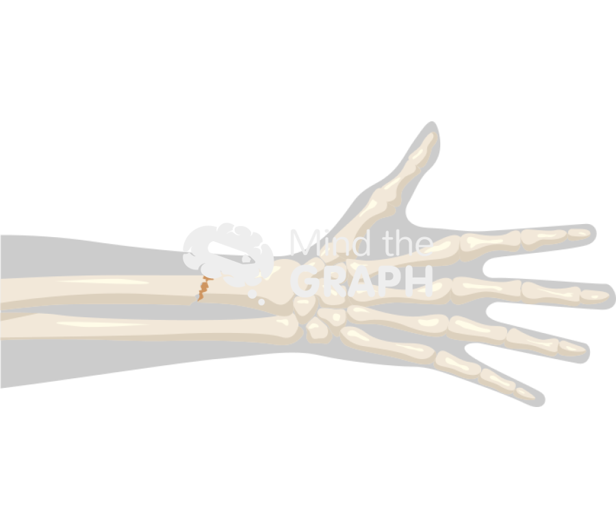 Radius fracture 2 body Icons, Symbols, Pictures, and Images