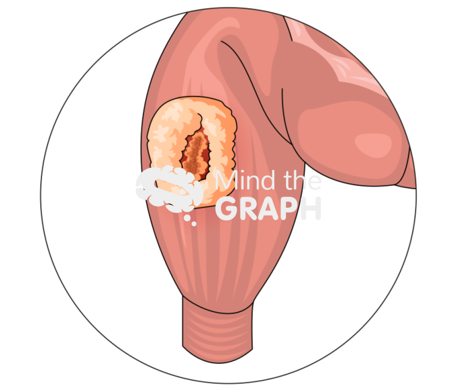 Rectal cancer external Icons, Symbols, Pictures, and Images