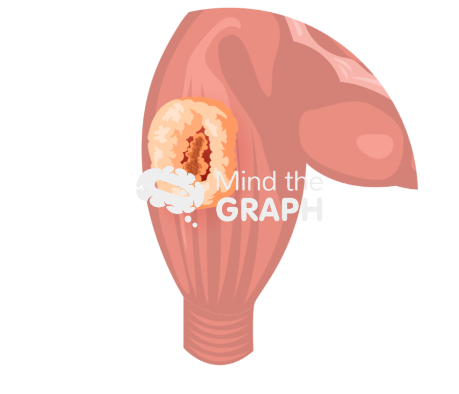 Rectal cancer external Icons, Symbols, Pictures, and Images