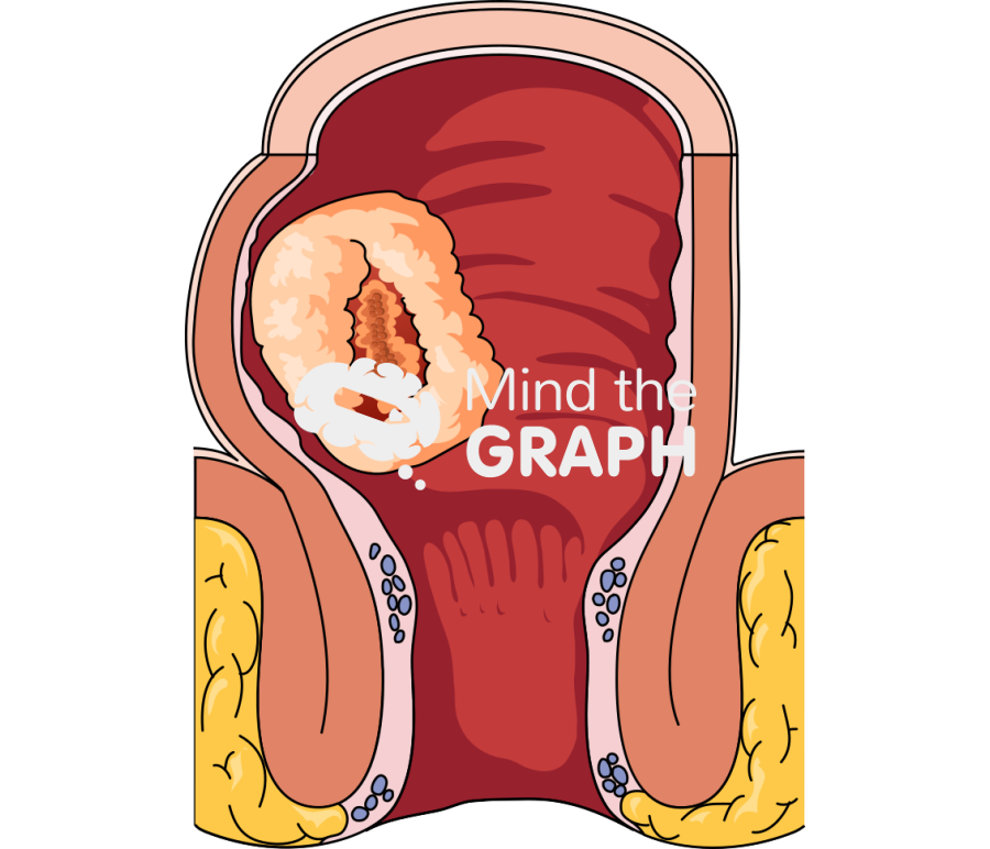 Rectal cancer internal Icons, Symbols, Pictures, and Images