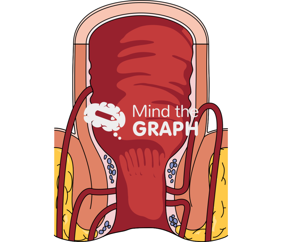 Rectum anal fistula Icons, Symbols, Pictures, and Images