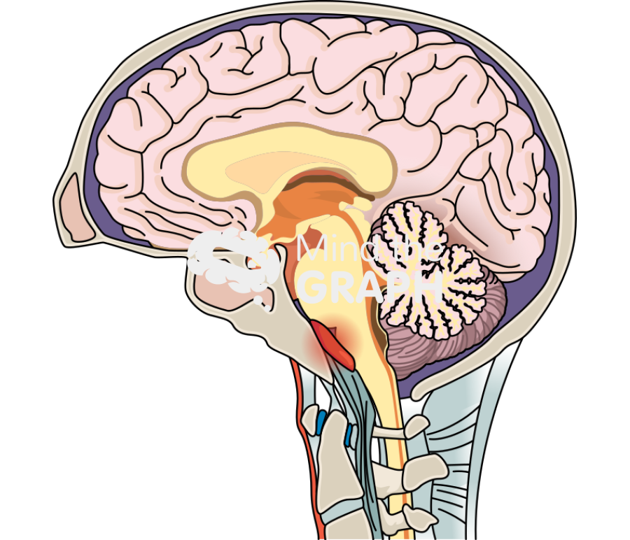 Retroclival hematoma brain Icons, Symbols, Pictures, and Images