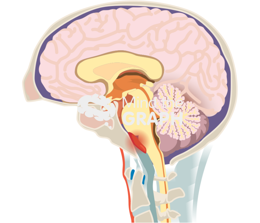 Retroclival hematoma brain Icons, Symbols, Pictures, and Images