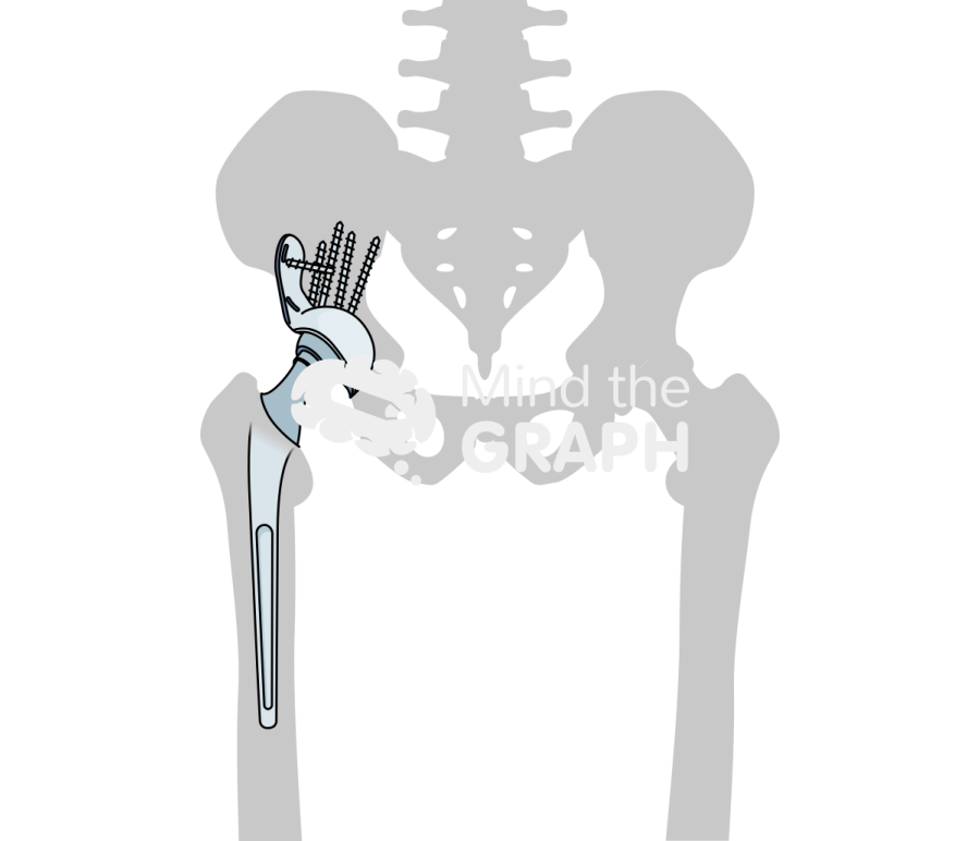 Revision socket total hip arthroplasty bone Icons, Symbols, Pictures, and Images