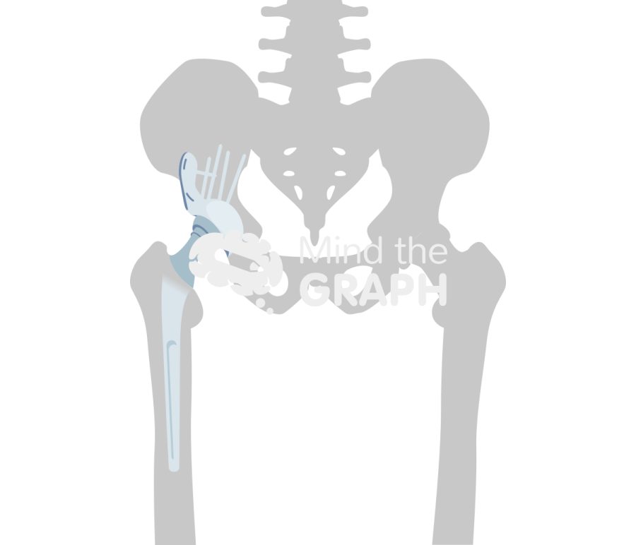 Revision socket total hip arthroplasty bone Icons, Symbols, Pictures, and Images