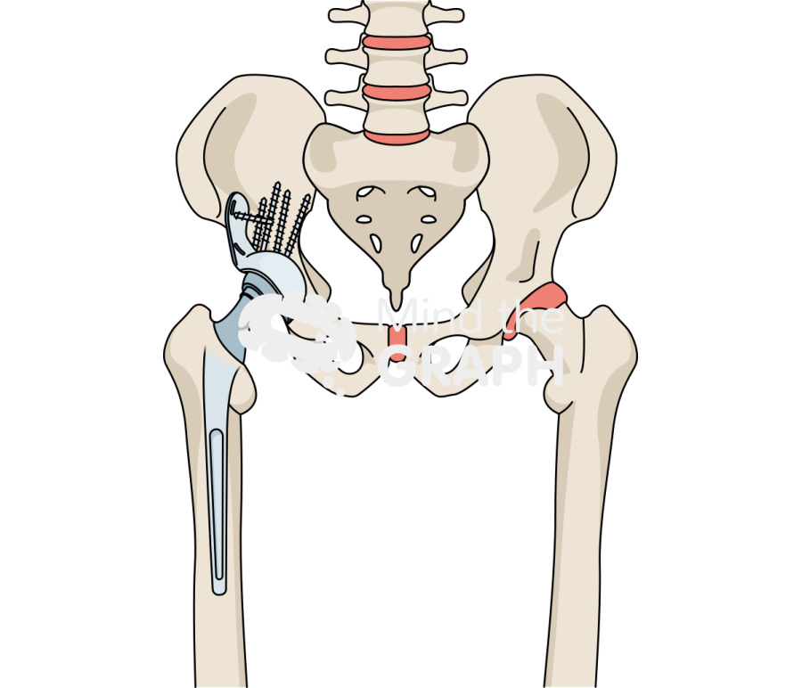Revision socket total hip arthroplasty bone full Icons, Symbols, Pictures, and Images