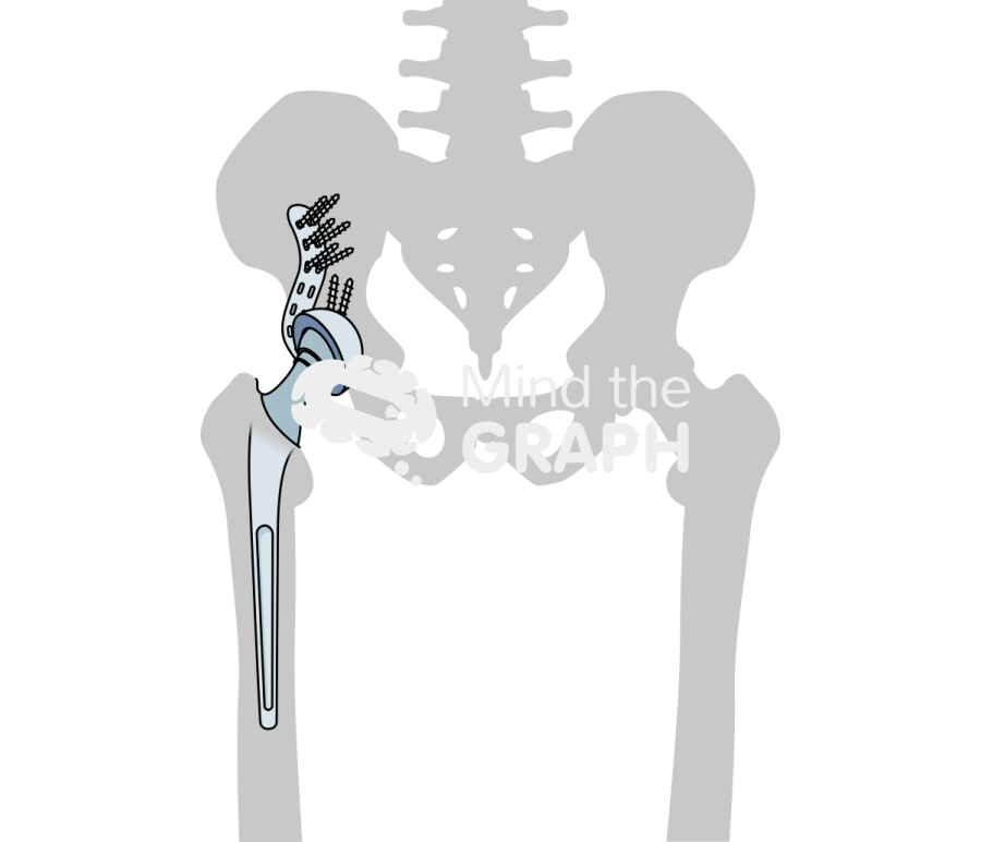 Revision socket total hip replacement bone Icons, Symbols, Pictures, and Images
