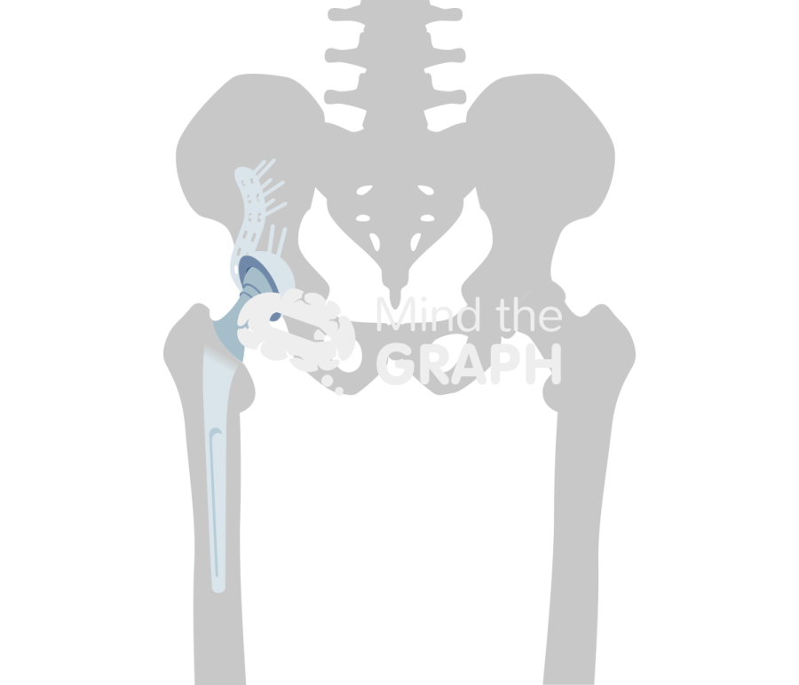 Revision socket total hip replacement bone Icons, Symbols, Pictures, and Images
