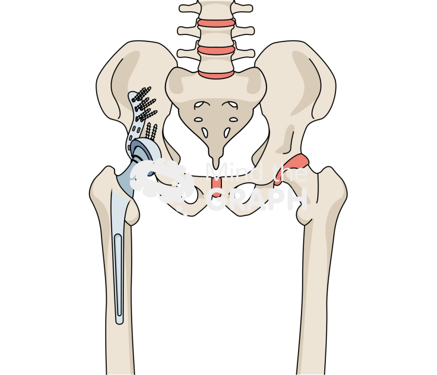 Revision socket total hip replacement bone full Icons, Symbols, Pictures, and Images