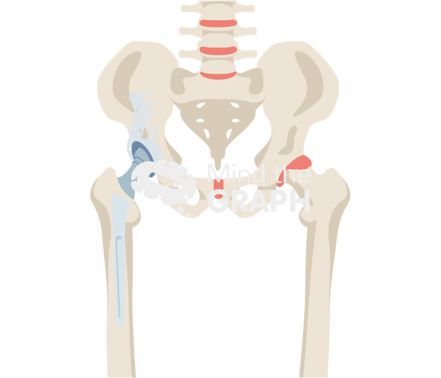 Revision socket total hip replacement bone full Icons, Symbols, Pictures, and Images