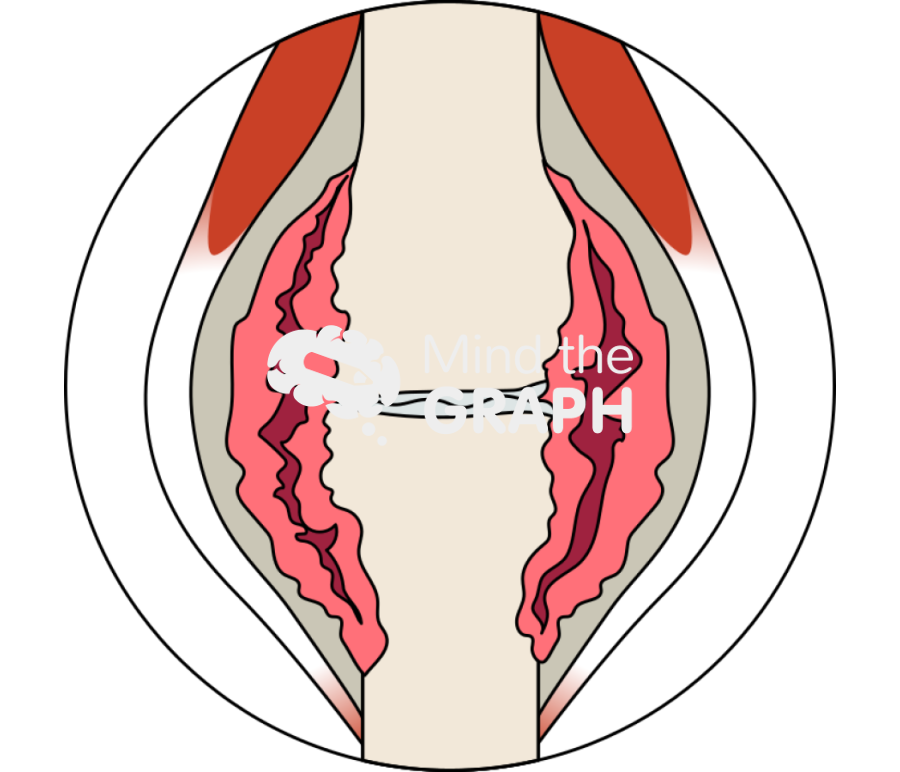 Rheumatoid arthritis severe zoom Icons, Symbols, Pictures, and Images
