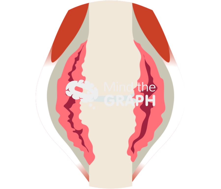 Rheumatoid arthritis severe zoom Icons, Symbols, Pictures, and Images