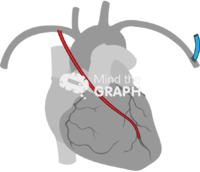 Right internal mammary artery contralateral arteriovenous fistula 2 Icons, Symbols, Pictures, and Images