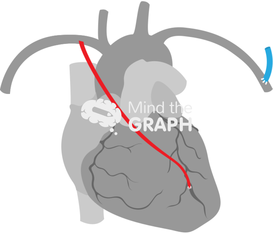 Right internal mammary artery contralateral arteriovenous fistula 2 Icons, Symbols, Pictures, and Images