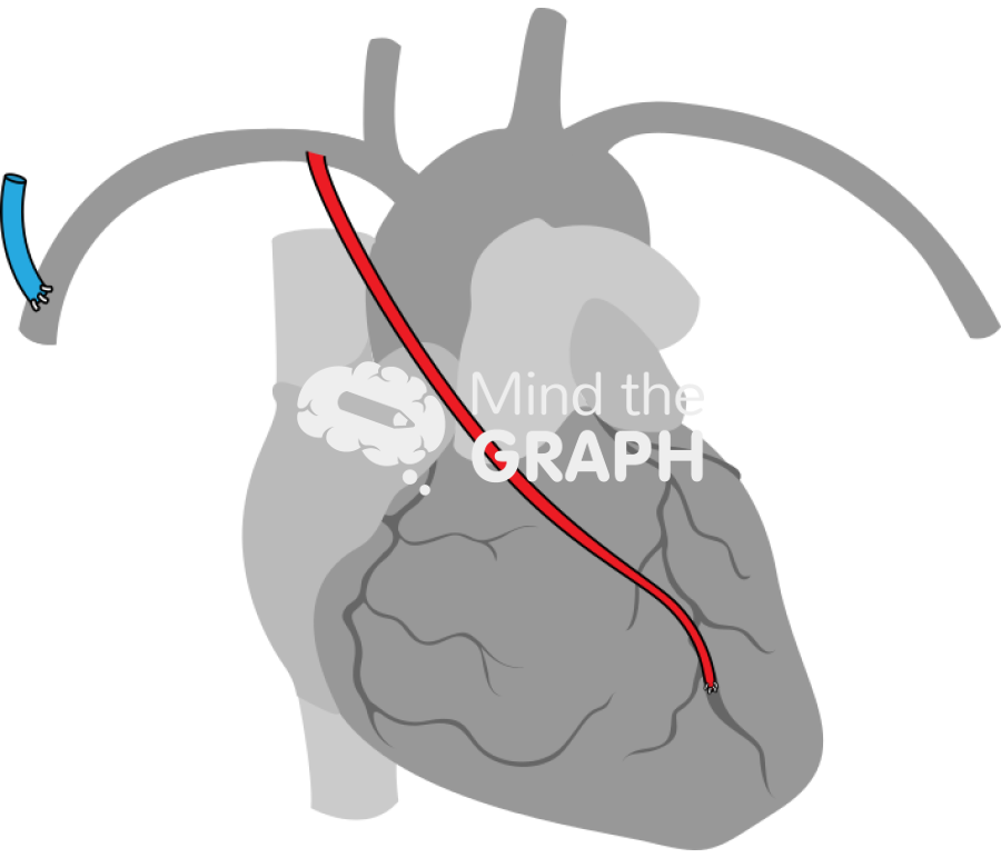 Right internal mammary artery ipsilateral arteriovenous fistula 2 Icons, Symbols, Pictures, and Images