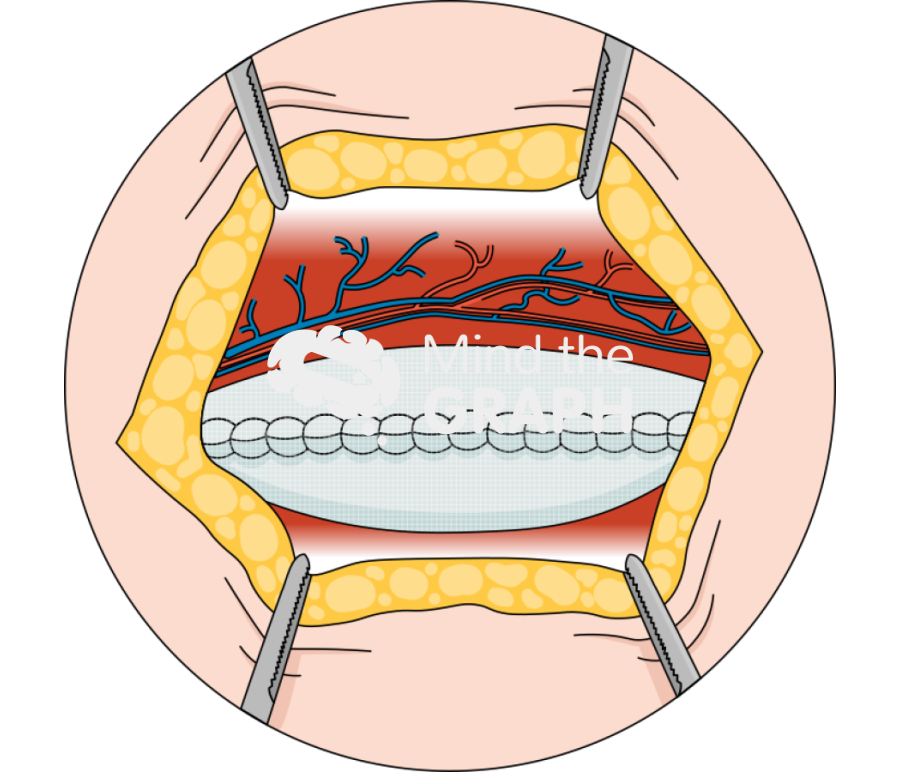 Rives stoppa hernia repair zoom Icons, Symbols, Pictures, and Images