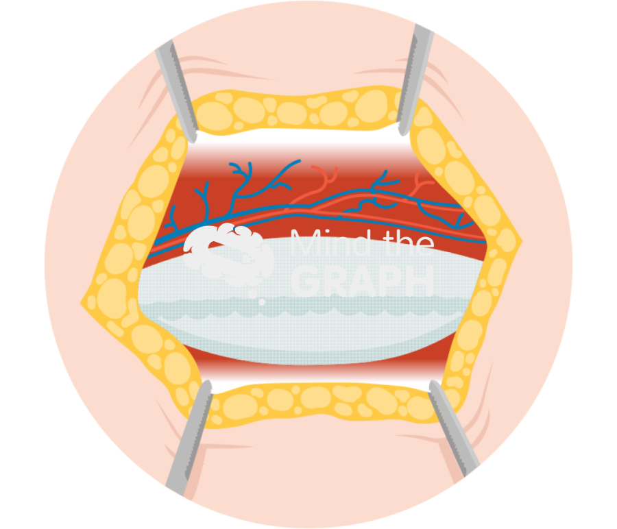 Rives stoppa hernia repair zoom Icons, Symbols, Pictures, and Images