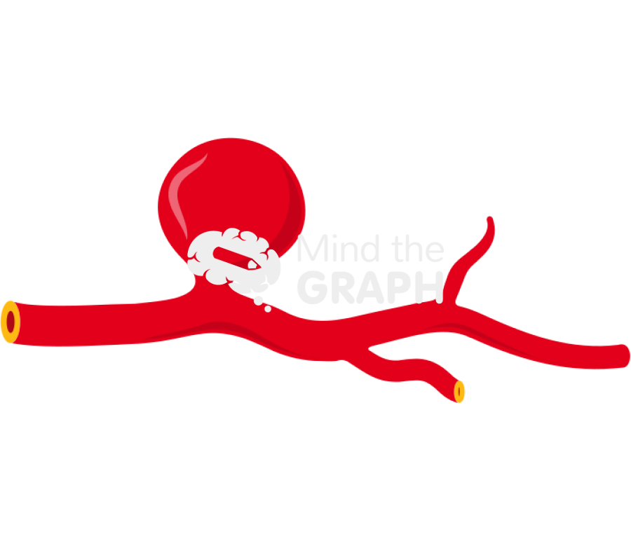 Saccular aneurysm closed Icons, Symbols, Pictures, and Images