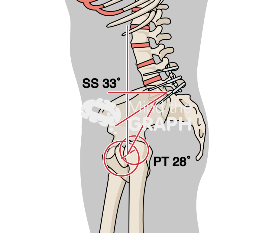 Sacral slope pelvic tilt after spinal fusion Icons, Symbols, Pictures, and Images