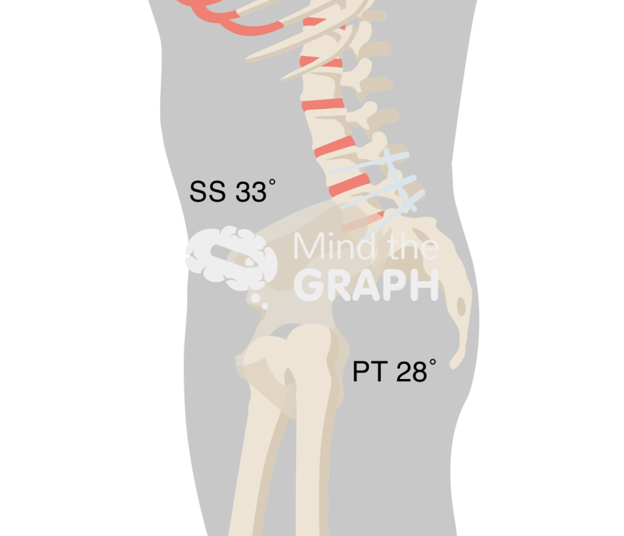 Sacral slope pelvic tilt after spinal fusion Icons, Symbols, Pictures, and Images