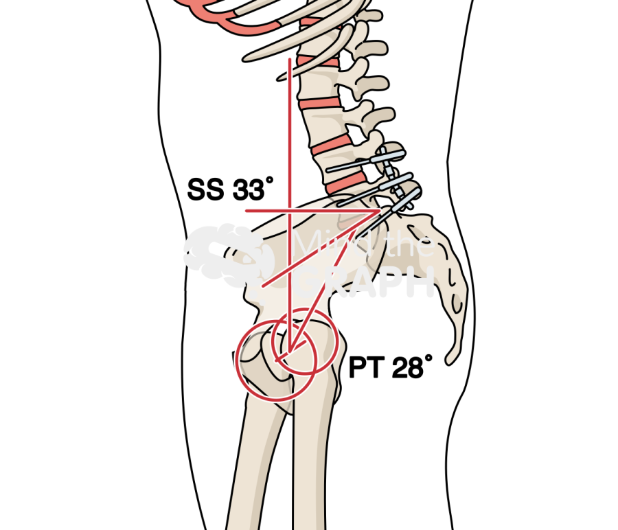 Sacral slope pelvic tilt after spinal fusion bone full Icons, Symbols, Pictures, and Images
