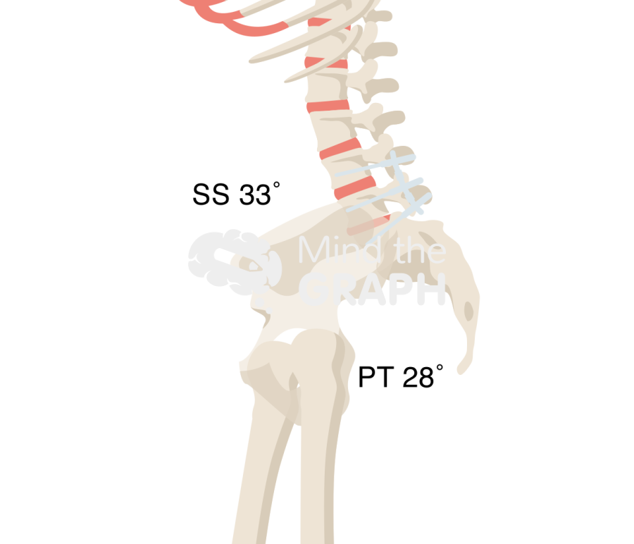 Sacral slope pelvic tilt after spinal fusion bone full Icons, Symbols, Pictures, and Images