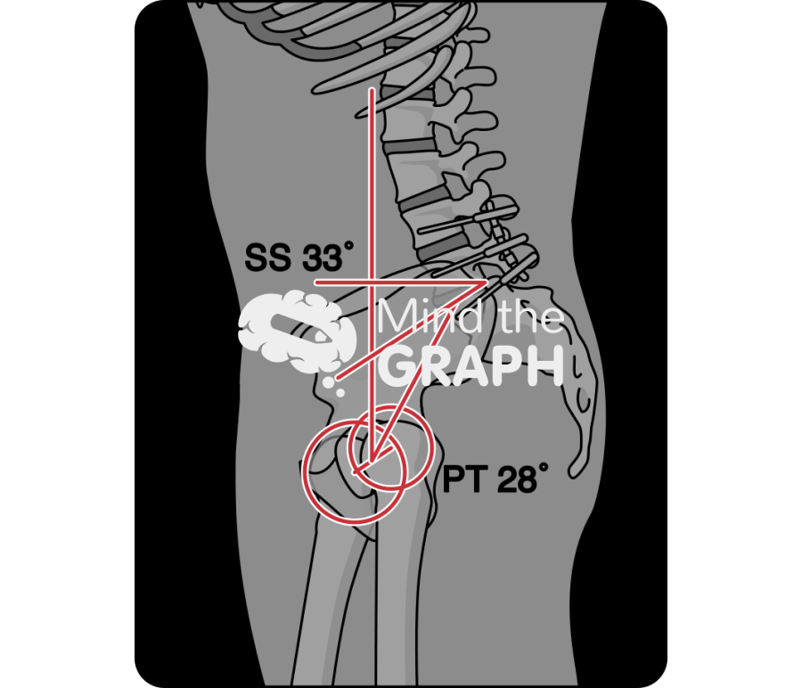 Sacral slope pelvic tilt after spinal fusion x ray Icons, Symbols, Pictures, and Images