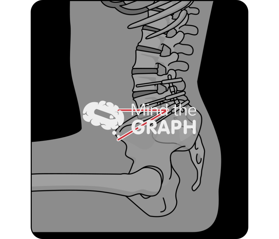 Sacral slope sitting after spinal fusion x ray