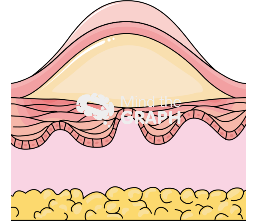 Second degree burn Icons, Symbols, Pictures, and Images