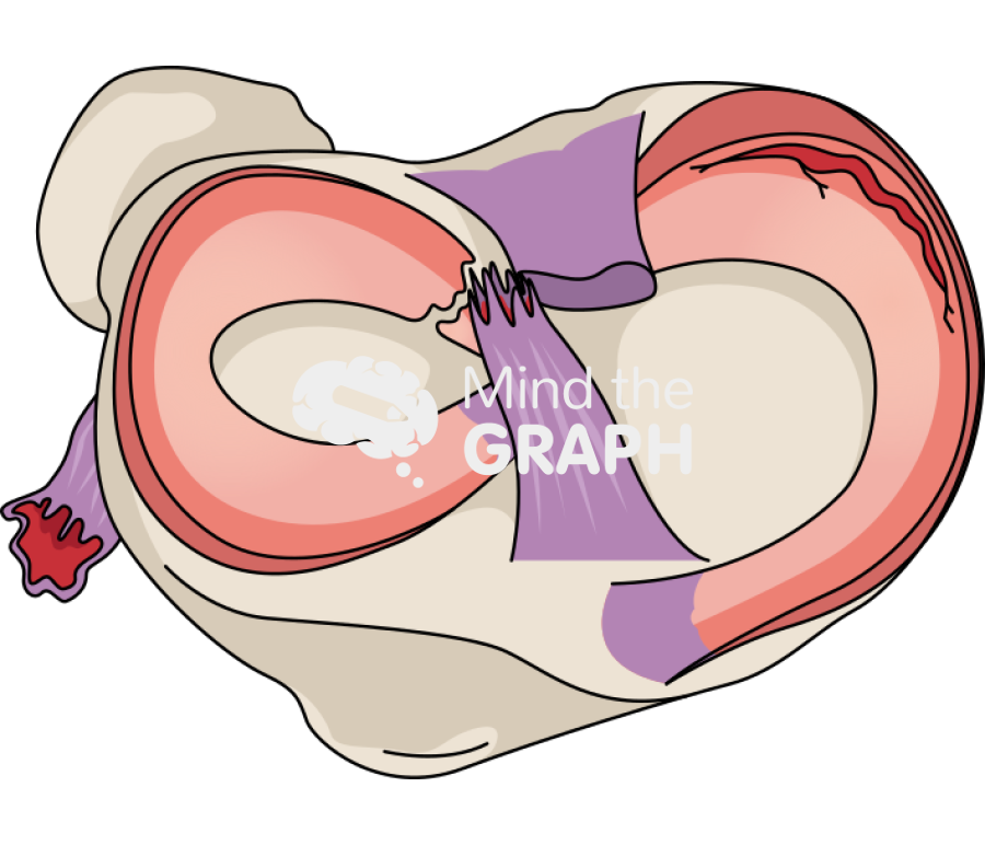 Free Secondary satbilizer injury anterior cruciate ligament injury ...
