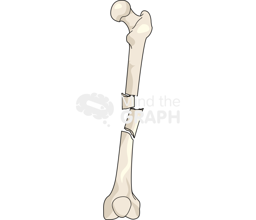 Segmental femur fracture Icons, Symbols, Pictures, and Images