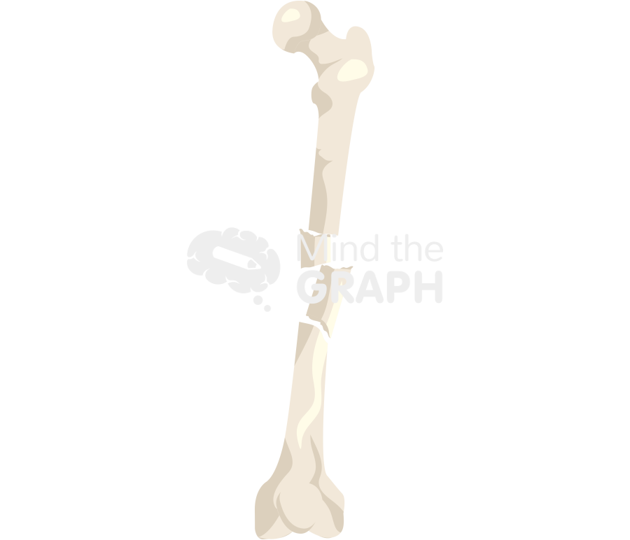 Segmental femur fracture Icons, Symbols, Pictures, and Images