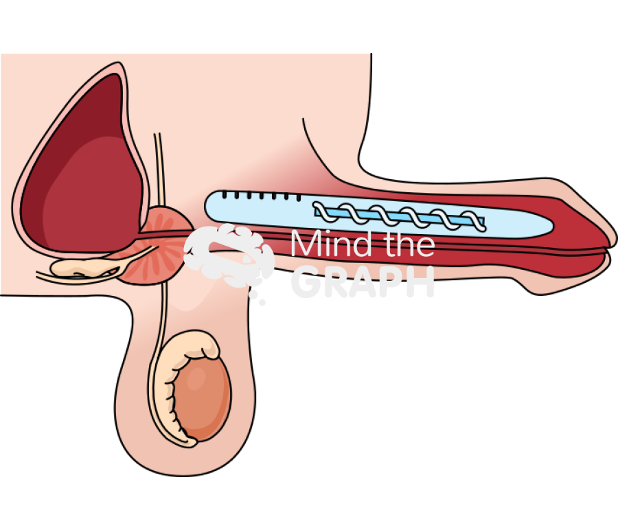 Semi rigid penile implant erect Icons, Symbols, Pictures, and Images