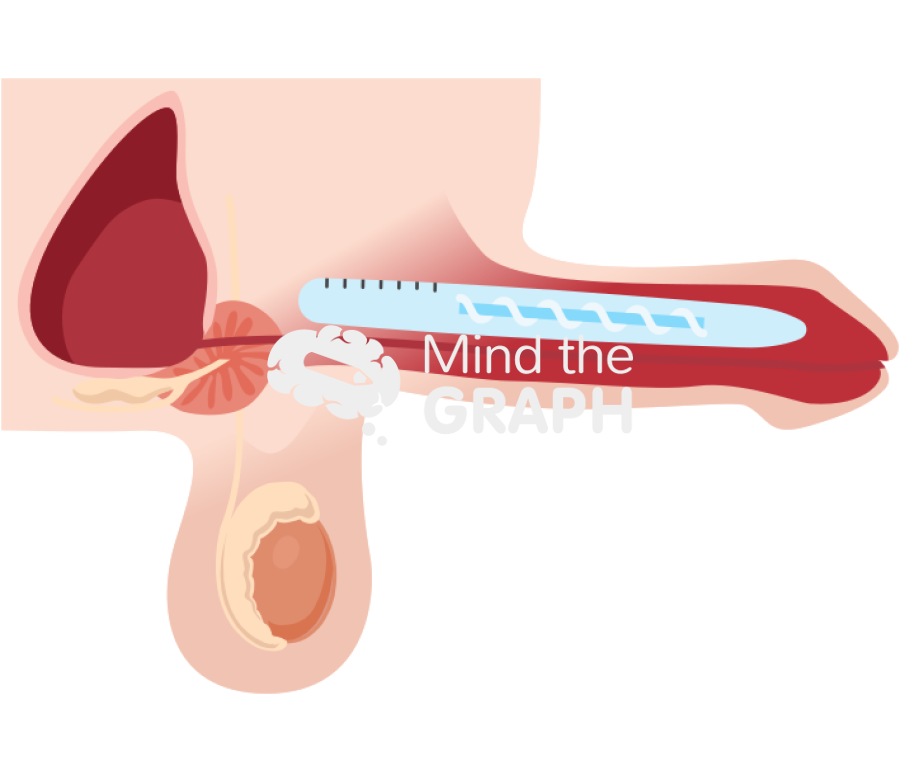 Semi rigid penile implant erect Icons, Symbols, Pictures, and Images