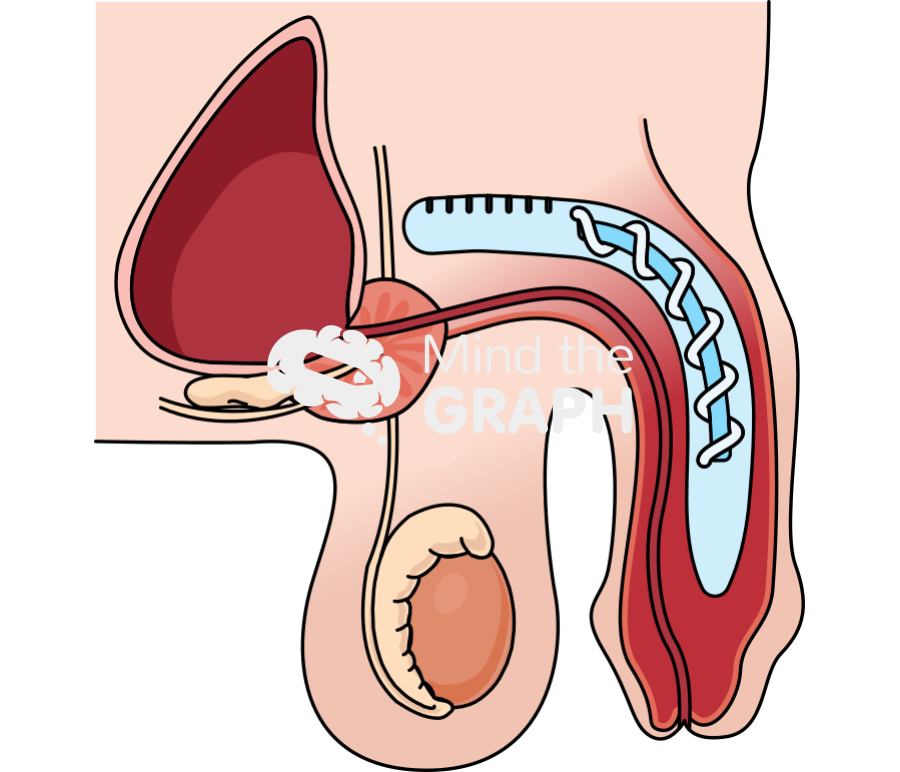 Semi rigid penile implant flaccid Icons, Symbols, Pictures, and Images