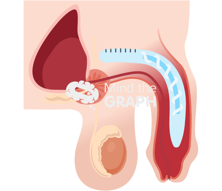 Semi rigid penile implant flaccid Icons, Symbols, Pictures, and Images